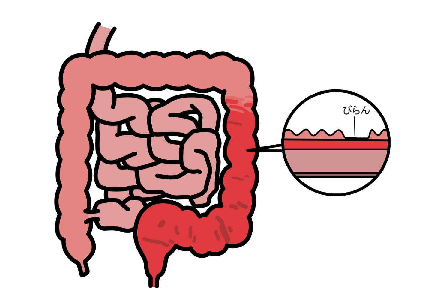 潰瘍性大腸炎の腸l 潰瘍性大腸炎(UC)の寛解は可能？症状が楽になる方法5選