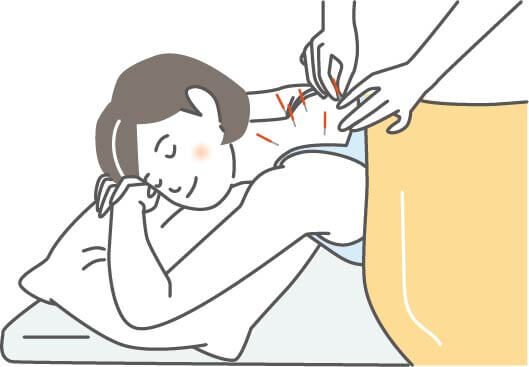 肩こりを鍼灸治療で改善するイメージ