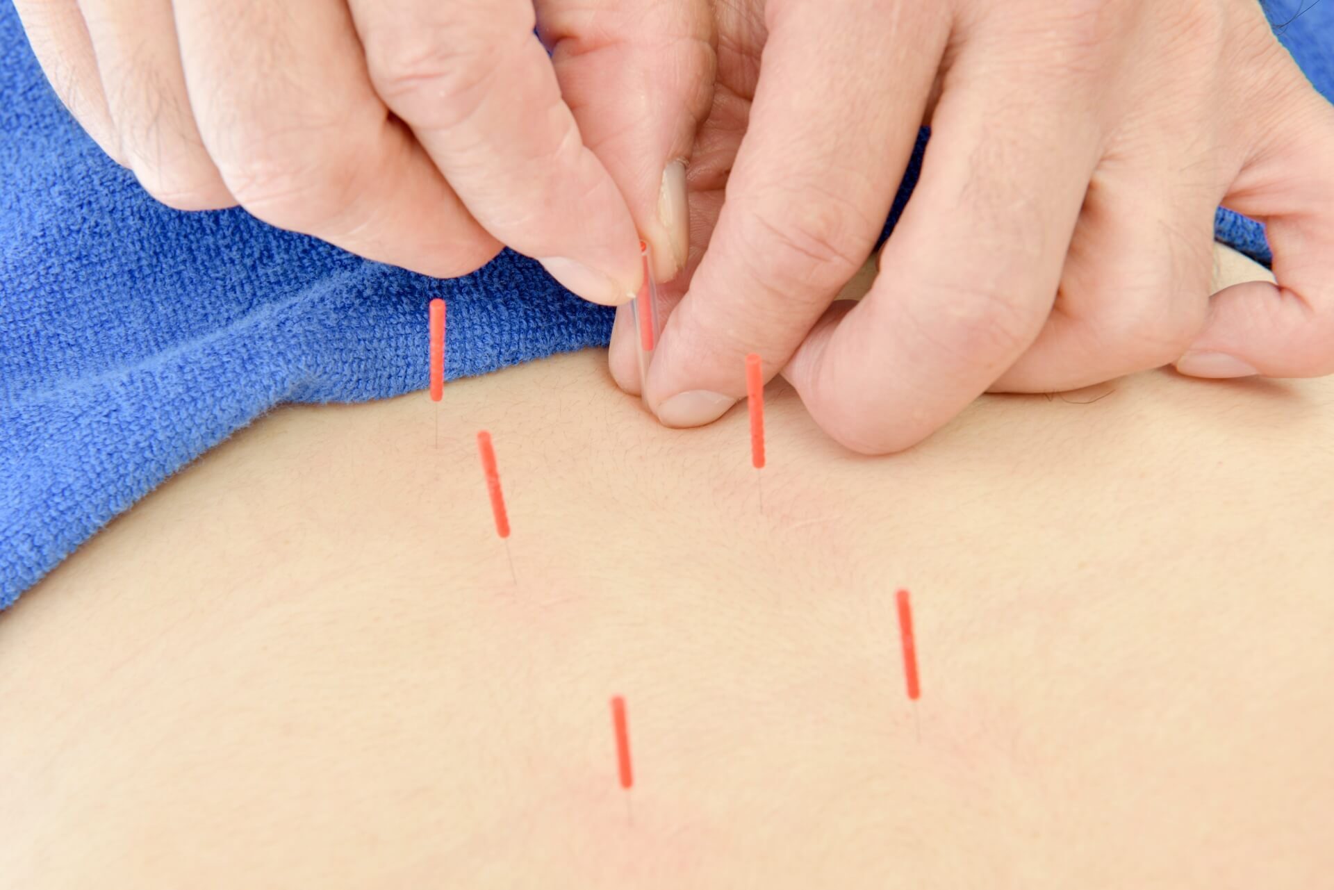 腰痛に対する鍼灸治療のイメージ